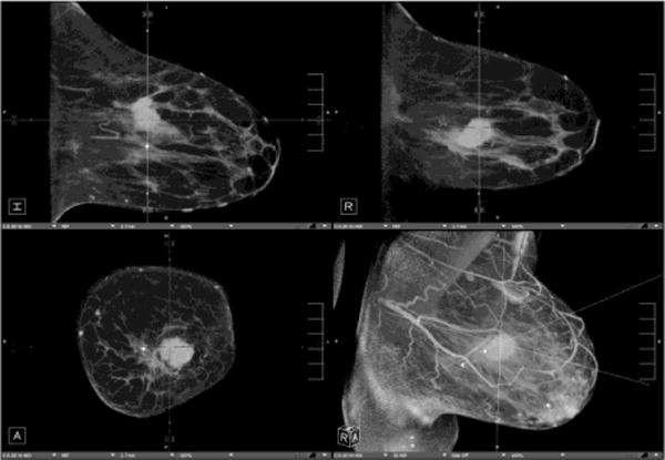 Breast CT